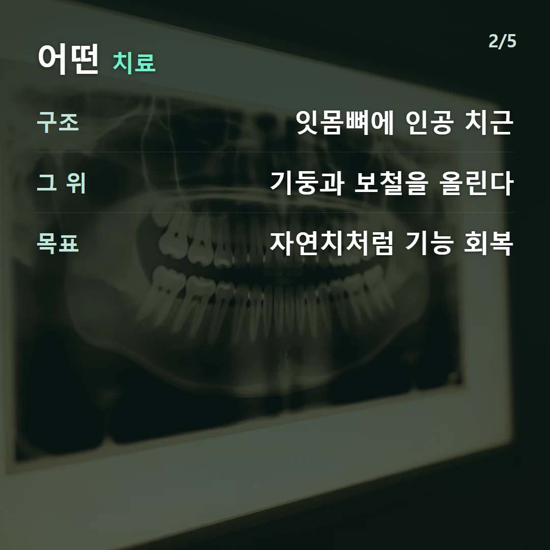 어떤 치료 — 구조 잇몸뼈에 인공 치근, 그 위 기둥과 보철을 올린다, 목표 자연치처럼 기능 회복