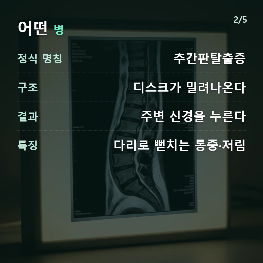 어떤 병 — 정식 명칭 추간판탈출증, 구조 디스크가 밀려나온다, 결과 주변 신경을 누른다, 특징 다리로 뻗치는 통증·저림